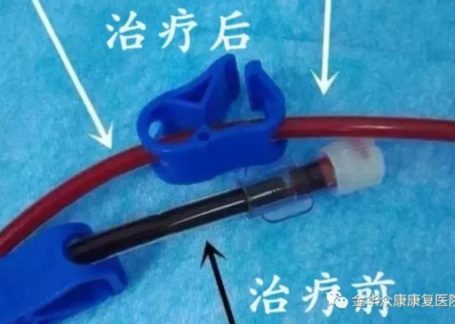 三氧自血療法可以治療什么疾??？